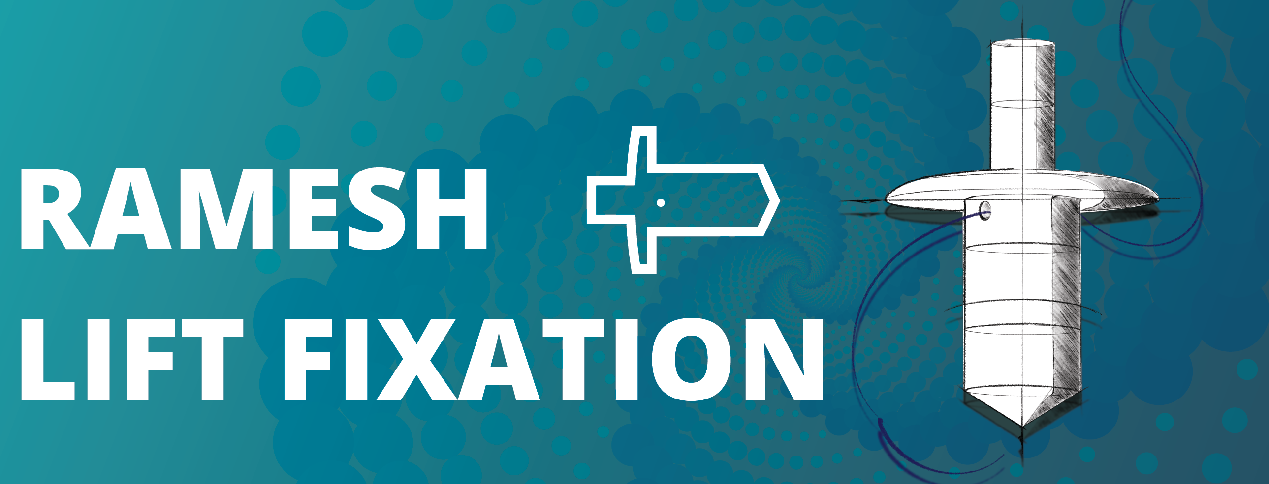 Ramesh lift fixation