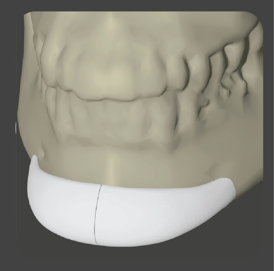SADDD-01 White curved two-piece chin implant for mandibular augmentation