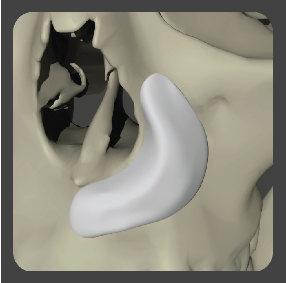 sad-02 White curved implant for paranasal augmentation