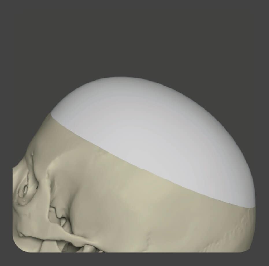 Dome-shaped white porous polyethylene implant for skull crown reconstruction