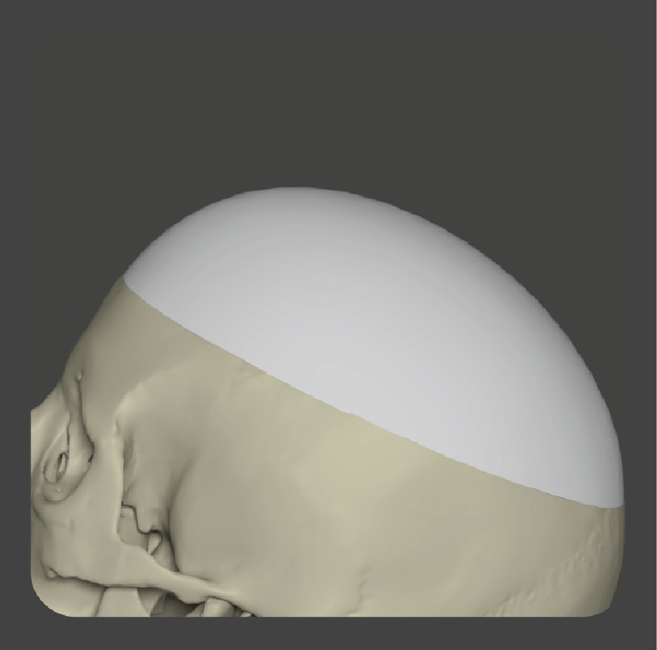 Dome-shaped white porous polyethylene implant for skull crown reconstruction