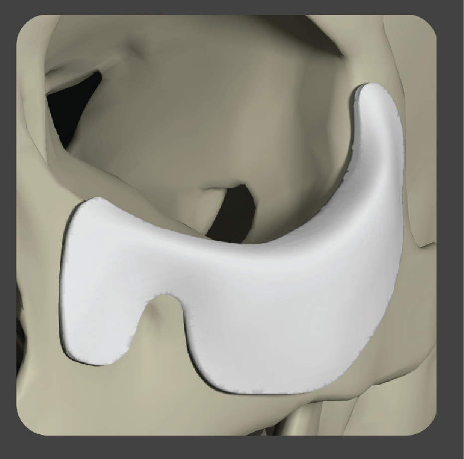 sad-04 White curved extended implant for comprehensive orbital rim coverage