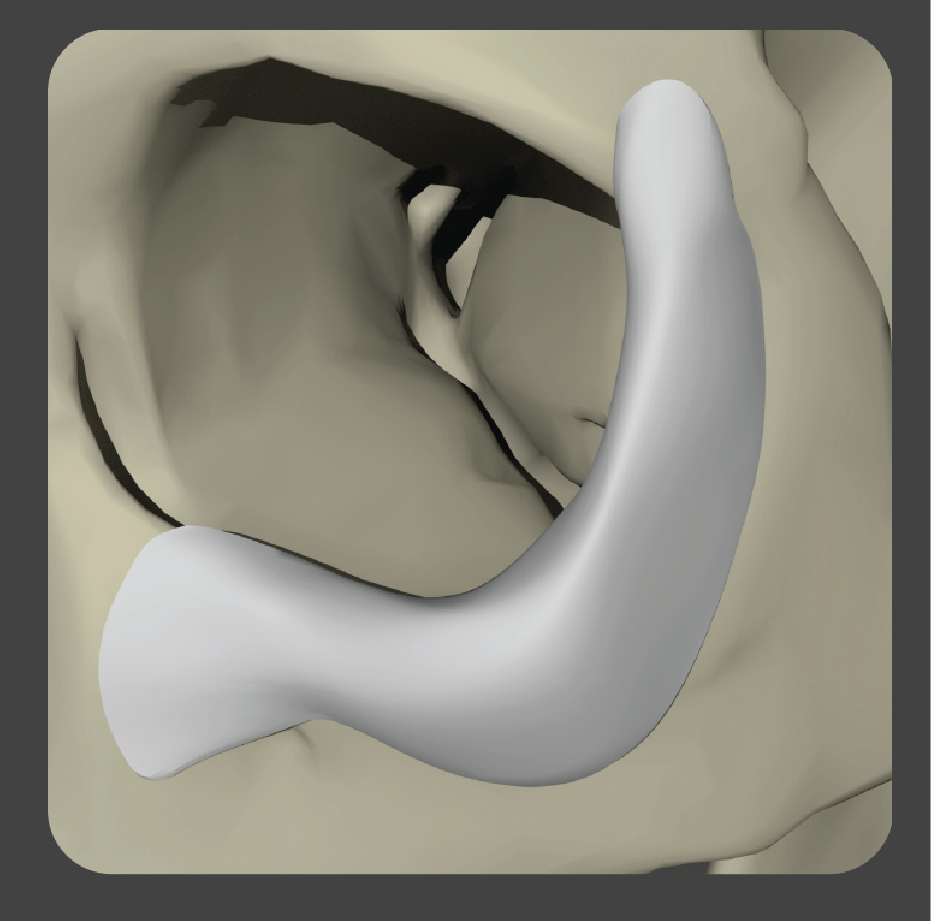 sad-05 White curved onlay implant for orbital rim augmentation