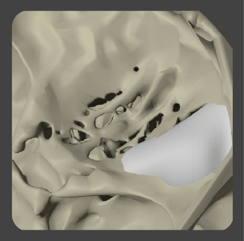 Curved white porous polyethylene implant for orbital and cheek bone area