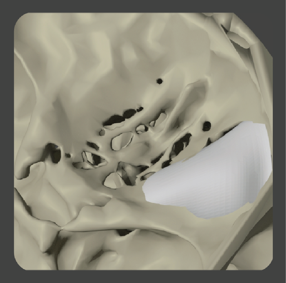 Curved white porous polyethylene implant for orbital and cheek bone area