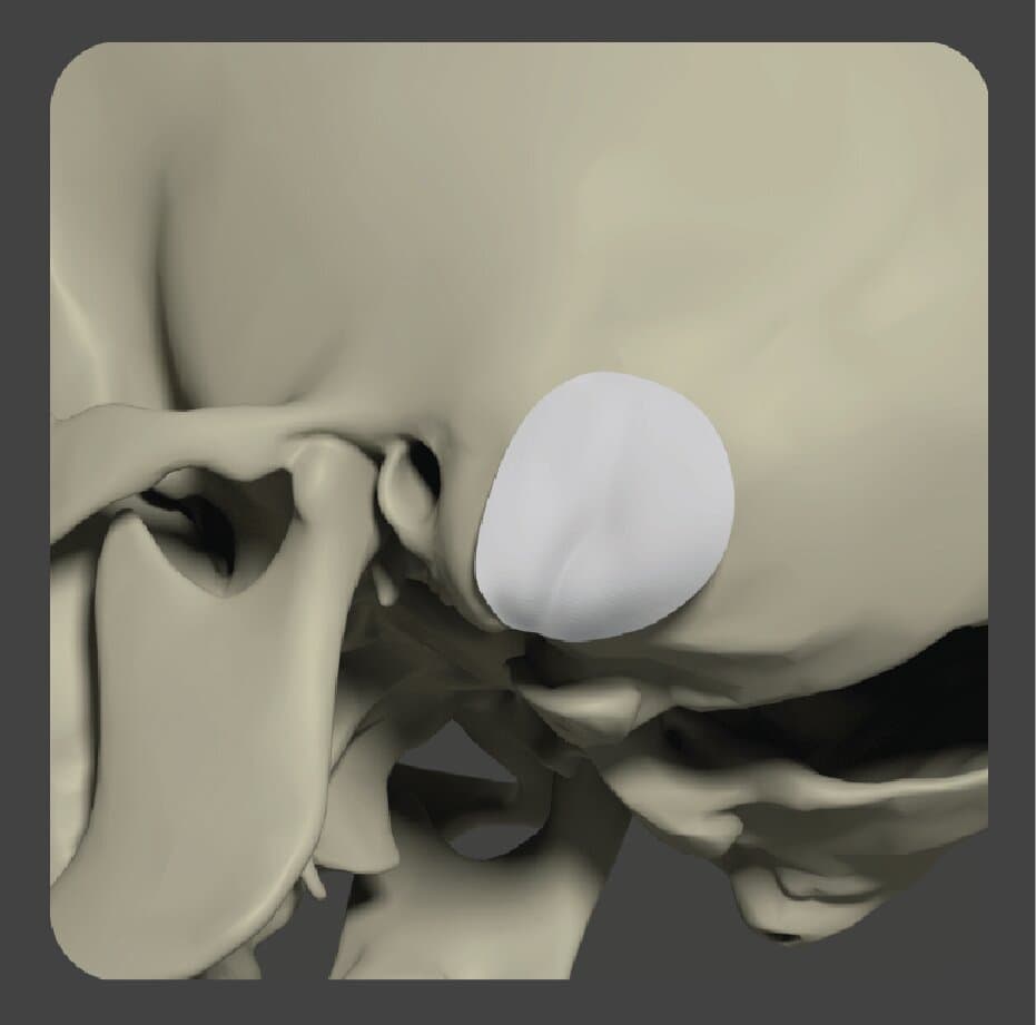 Curved white porous polyethylene implant shaped for posterior skull reconstruction