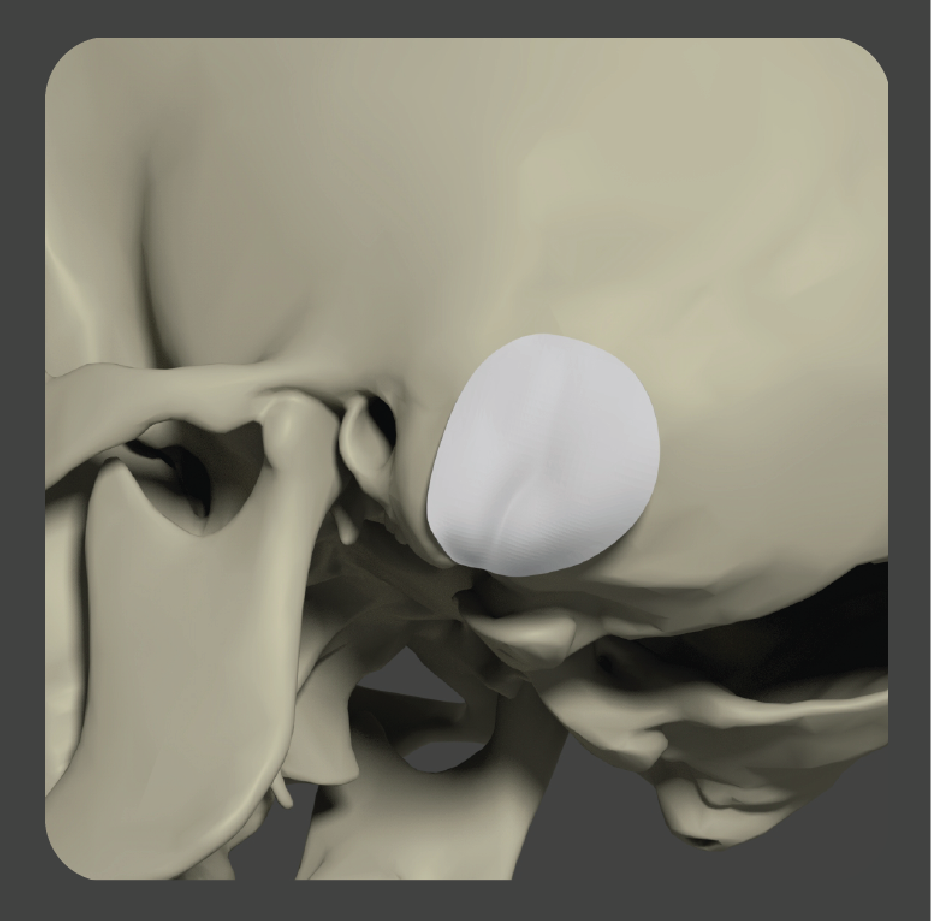 Curved white porous polyethylene implant shaped for posterior skull reconstruction