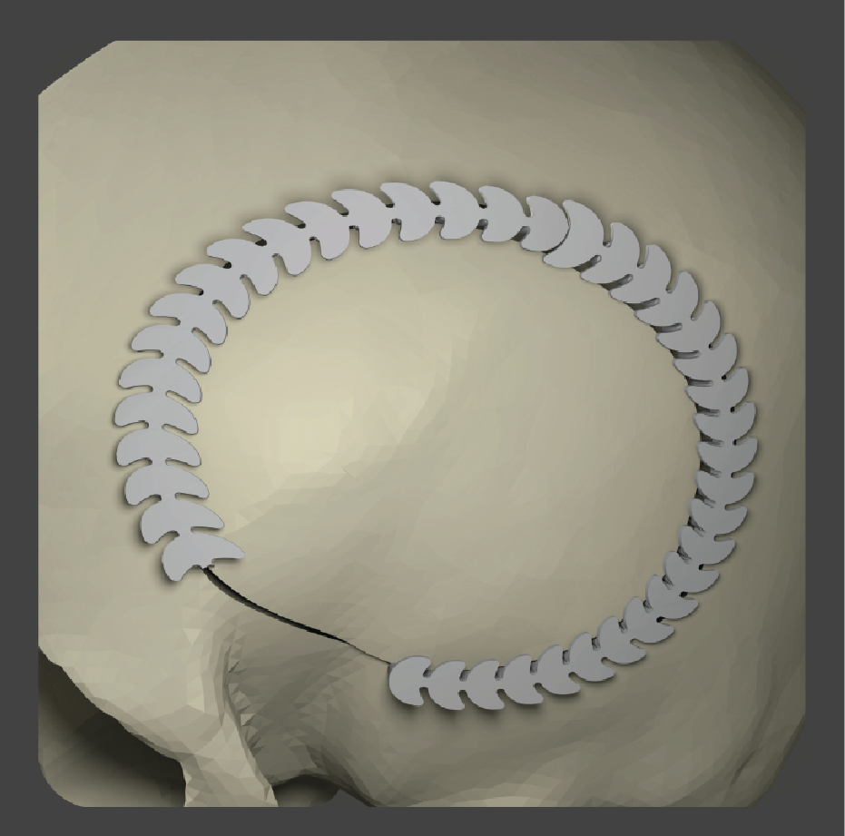 Curved white strip implant for filling surgical gaps