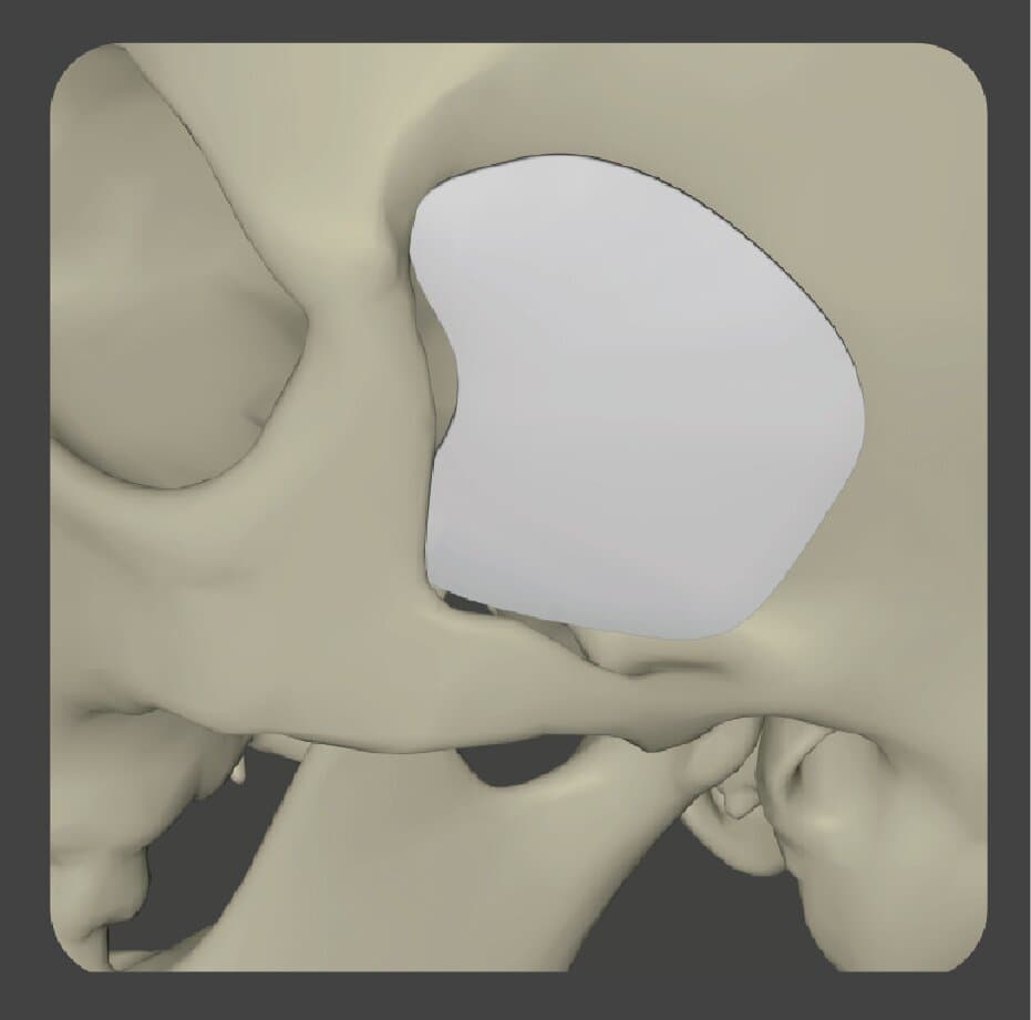 Curved white porous polyethylene implant shaped for pterional skull area