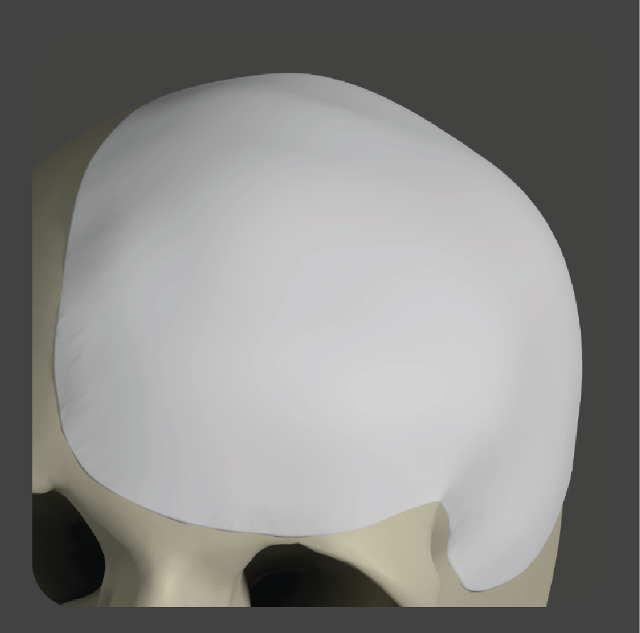 Dome-shaped white porous polyethylene implant for skull crown reconstruction
