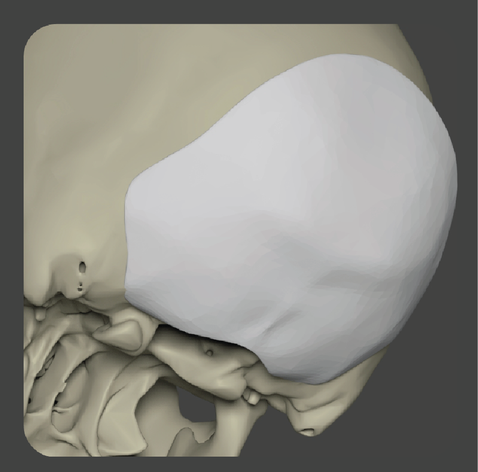 Curved white implant shaped for back of skull reconstruction
