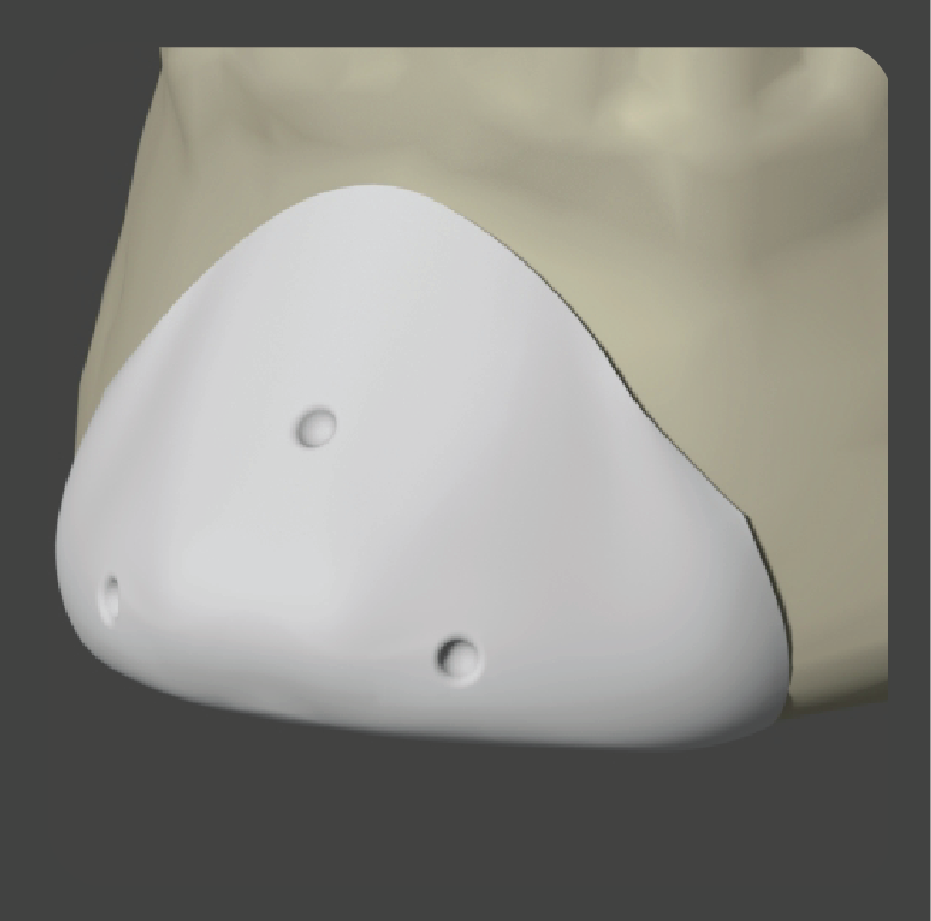 sad-15 White dome-shaped chin implant for subtle mandibular enhancement