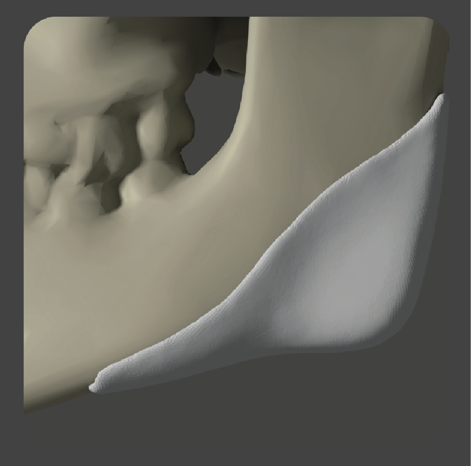 sad-16 White angular implant for jaw angle augmentation