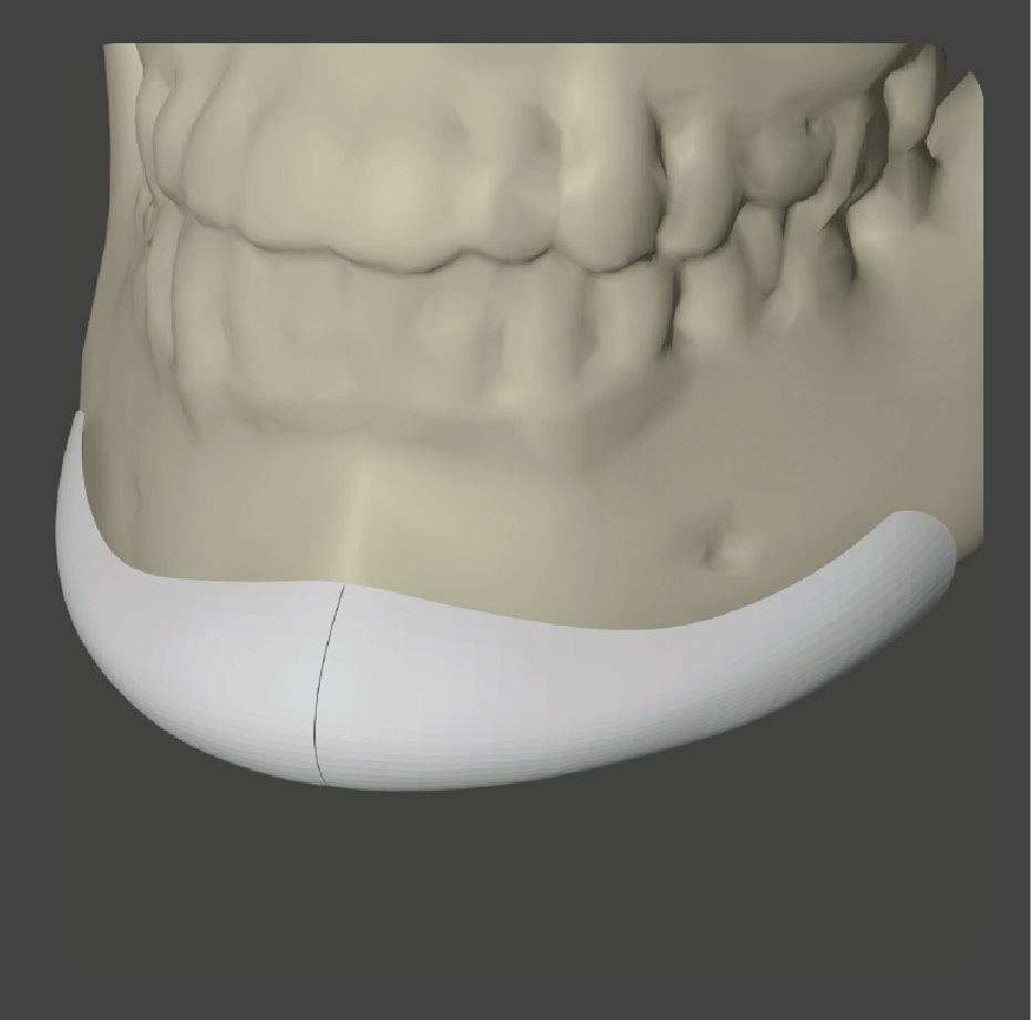 sad-17 White curved two-piece chin implant for mandibular augmentation