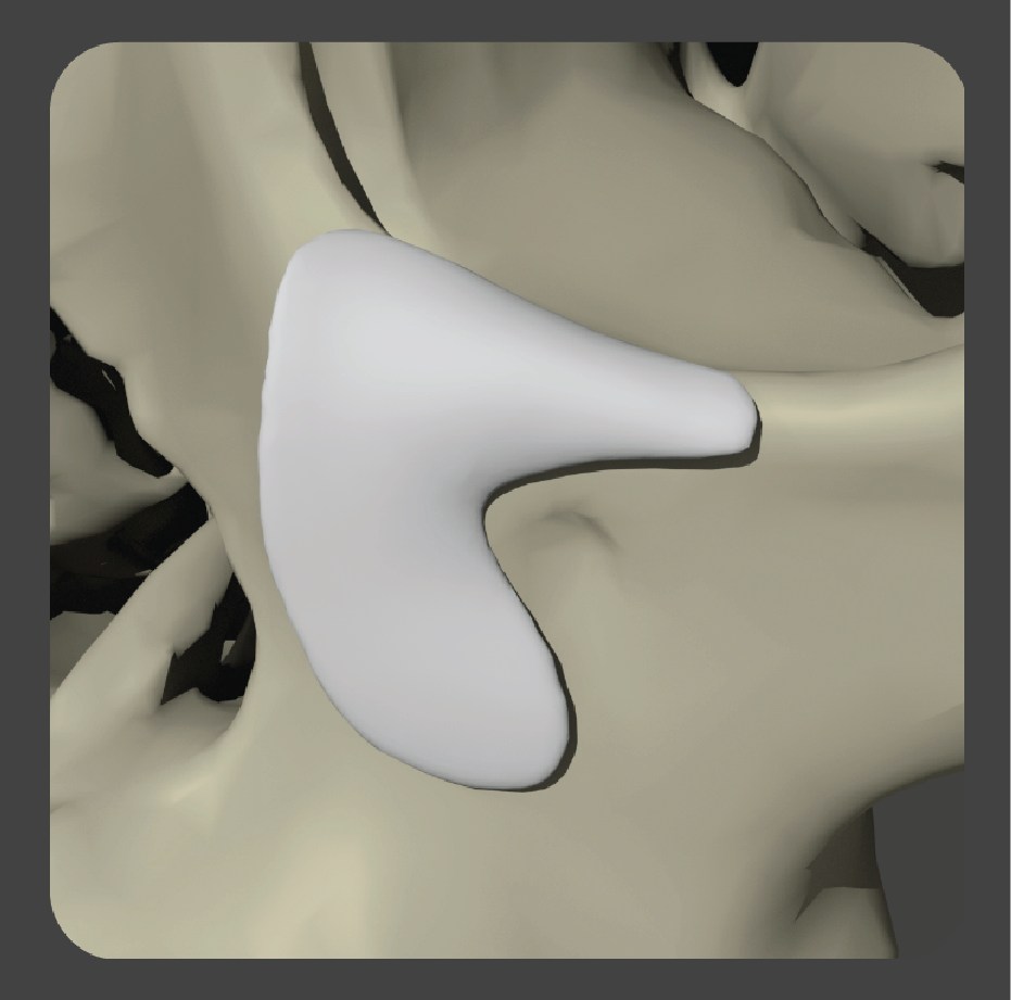 sad-18 White curved L-shaped implant for medial orbital rim reconstruction