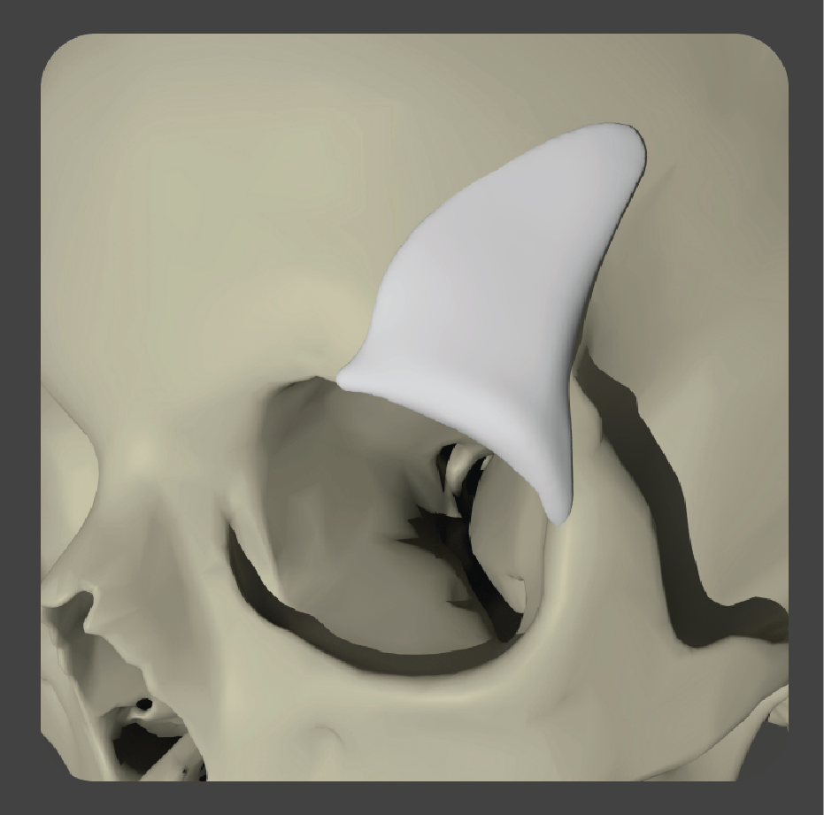 sad-19 White curved triangular implant for upper lateral orbital rim