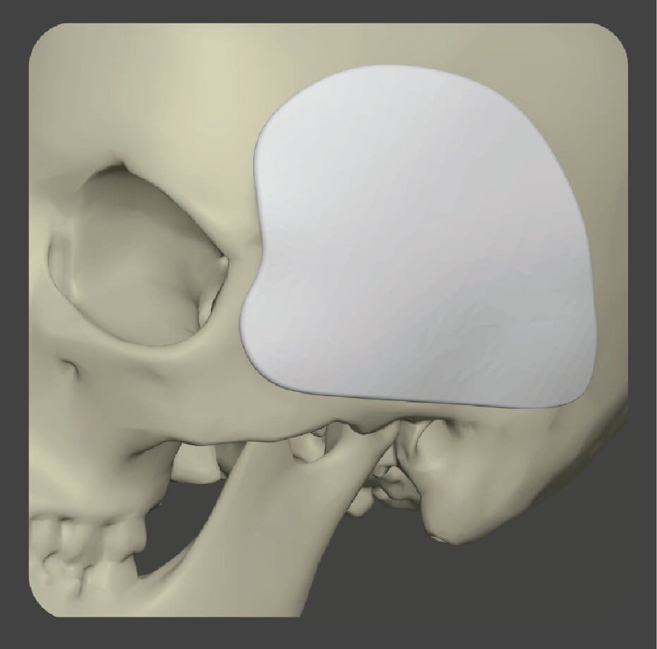 Curved white implant with grid pattern for temporal area