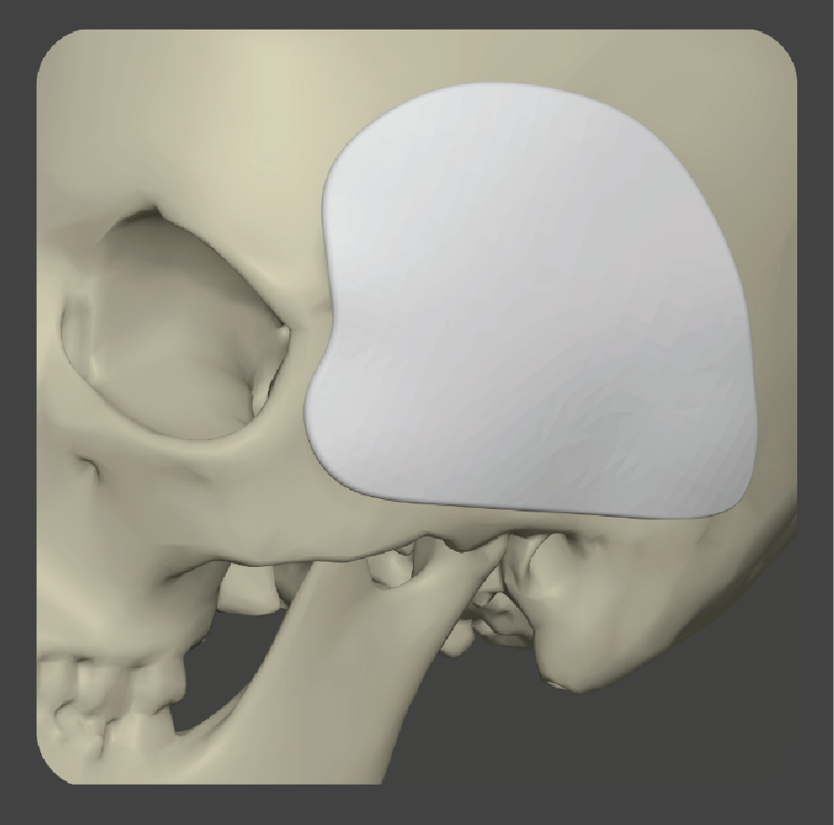 Curved white implant with grid pattern for temporal area