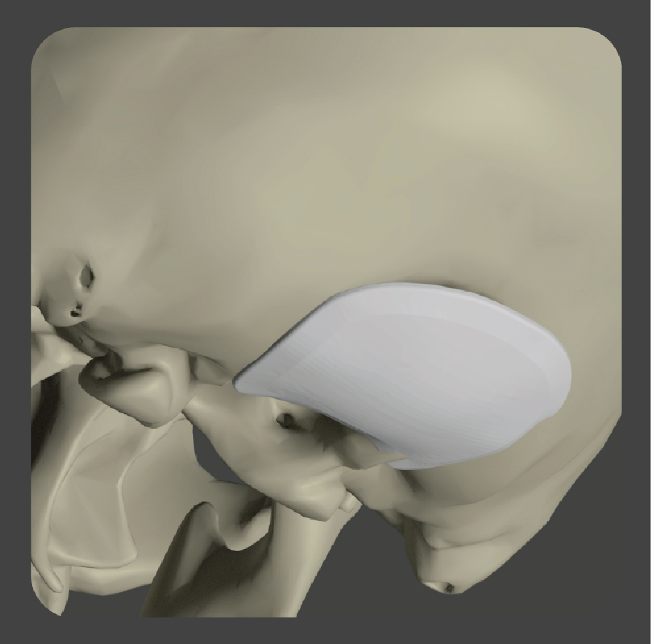 Curved white plate implant for posterior skull reconstruction