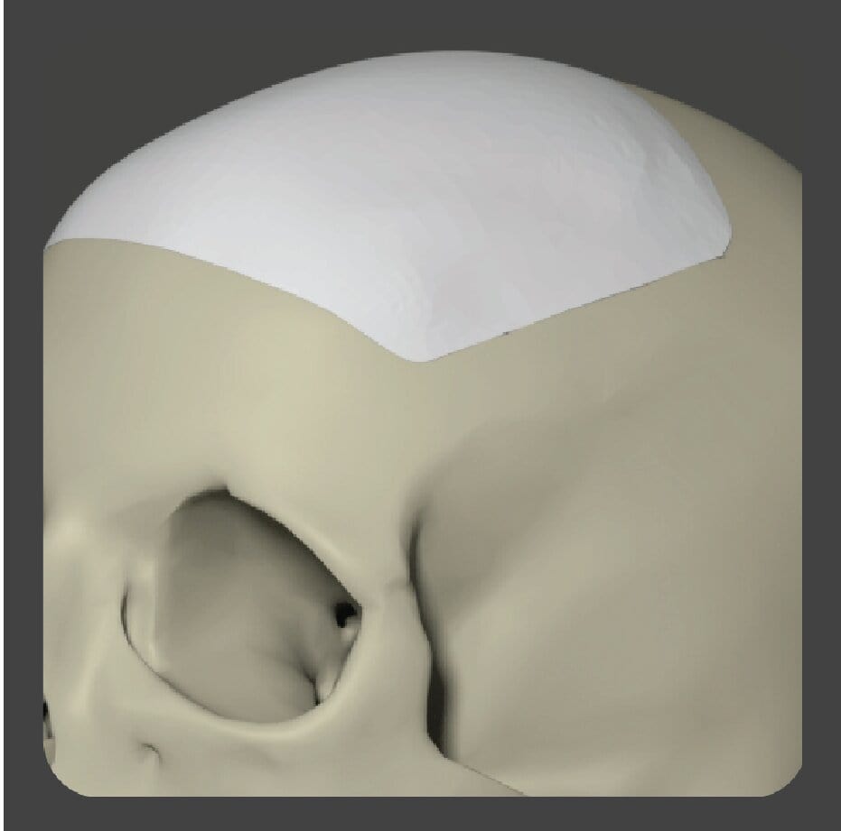 Curved white porous polyethylene implant with uniform grid pattern