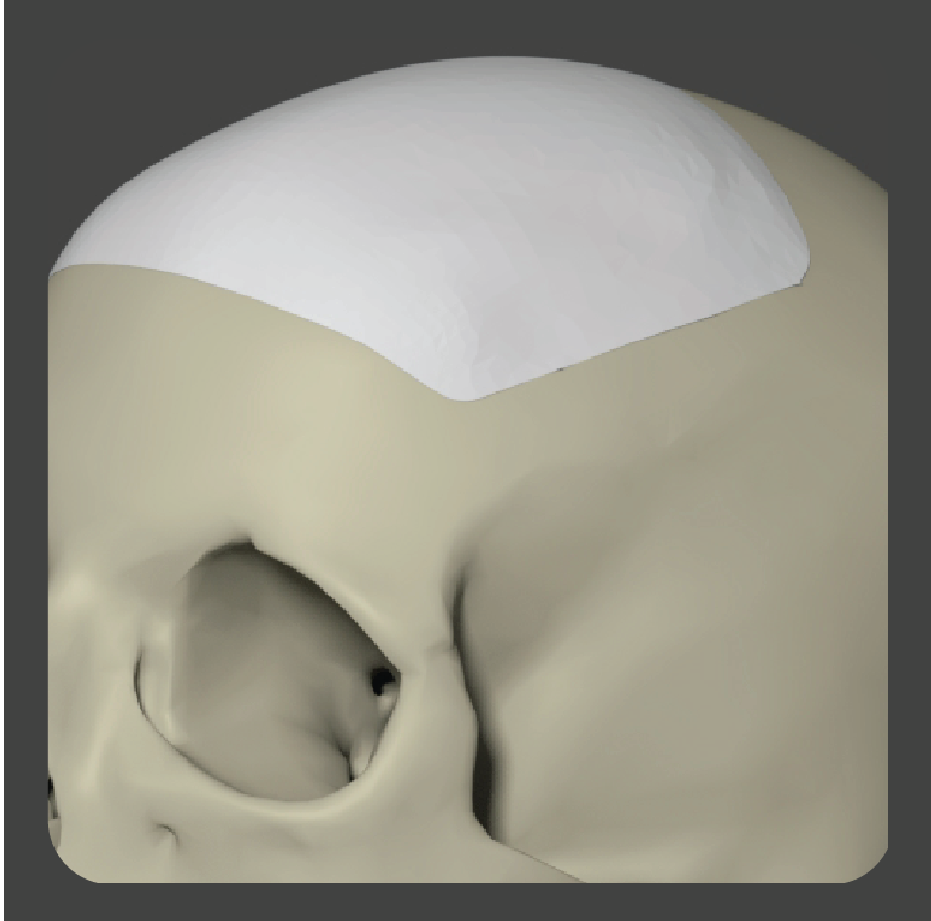 Curved white porous polyethylene implant with uniform grid pattern