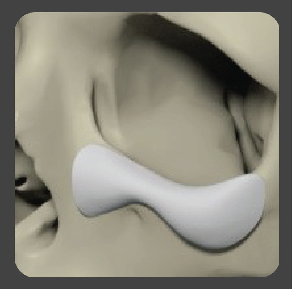 sadd-03 White curved rim implant for lower orbital bone reconstruction