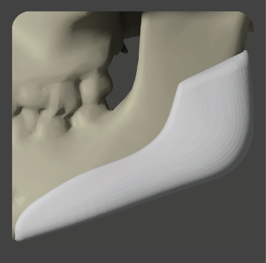 sadd-04 White angular implant for jaw angle augmentation