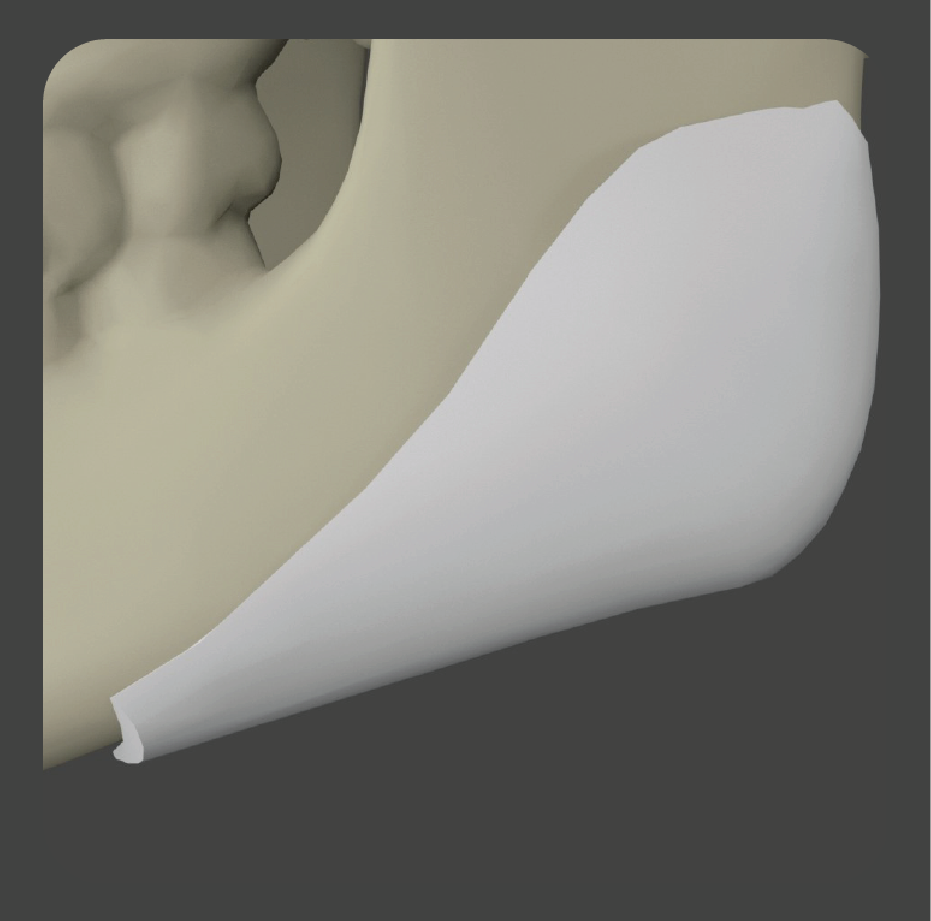 sadd-05 White contoured angular implant for jaw angle definition