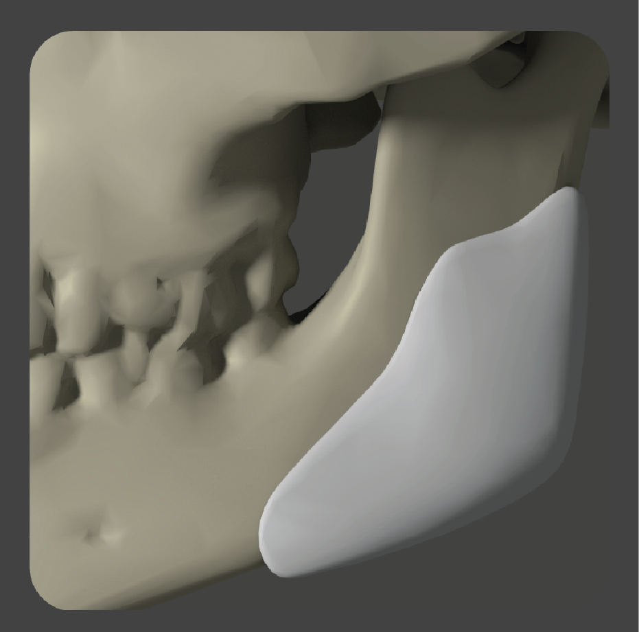 sadd-06 White curved implant for lateral jaw augmentation