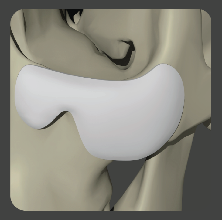 sadd-08 White angular rim implant for midface structural support