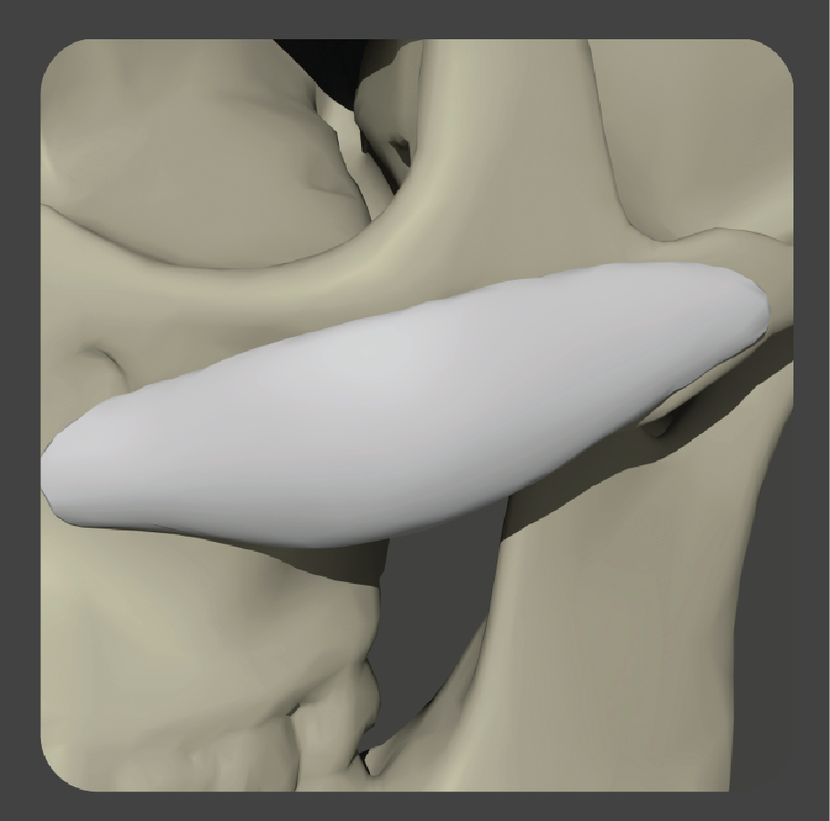 sadd-10 White elongated malar implant with extended cheek coverage