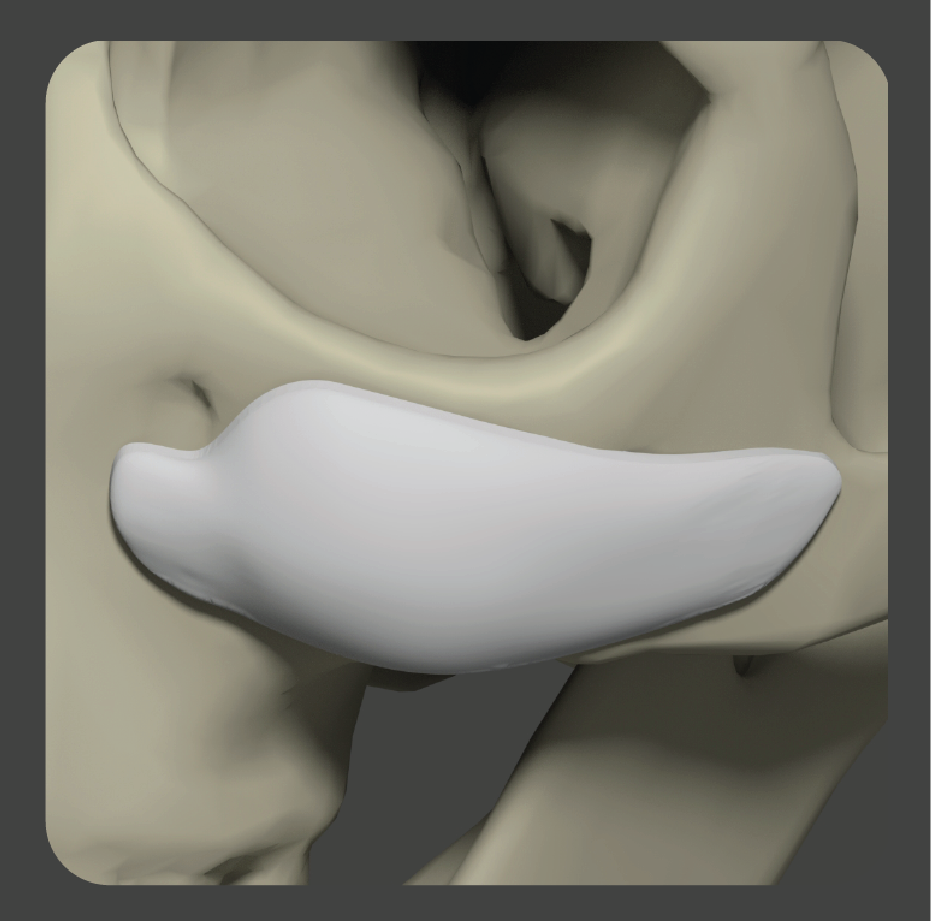 sadd-11 White curved malar implant for cheek augmentation