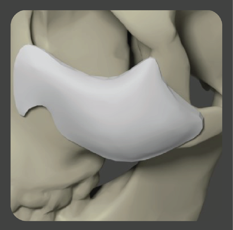 sadd-12 White curved contour implant for midface augmentation