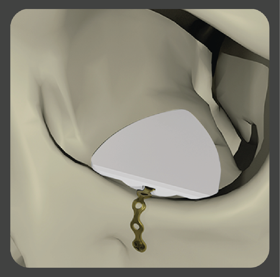 stupid-01 White flat rectangular implant with single central channel