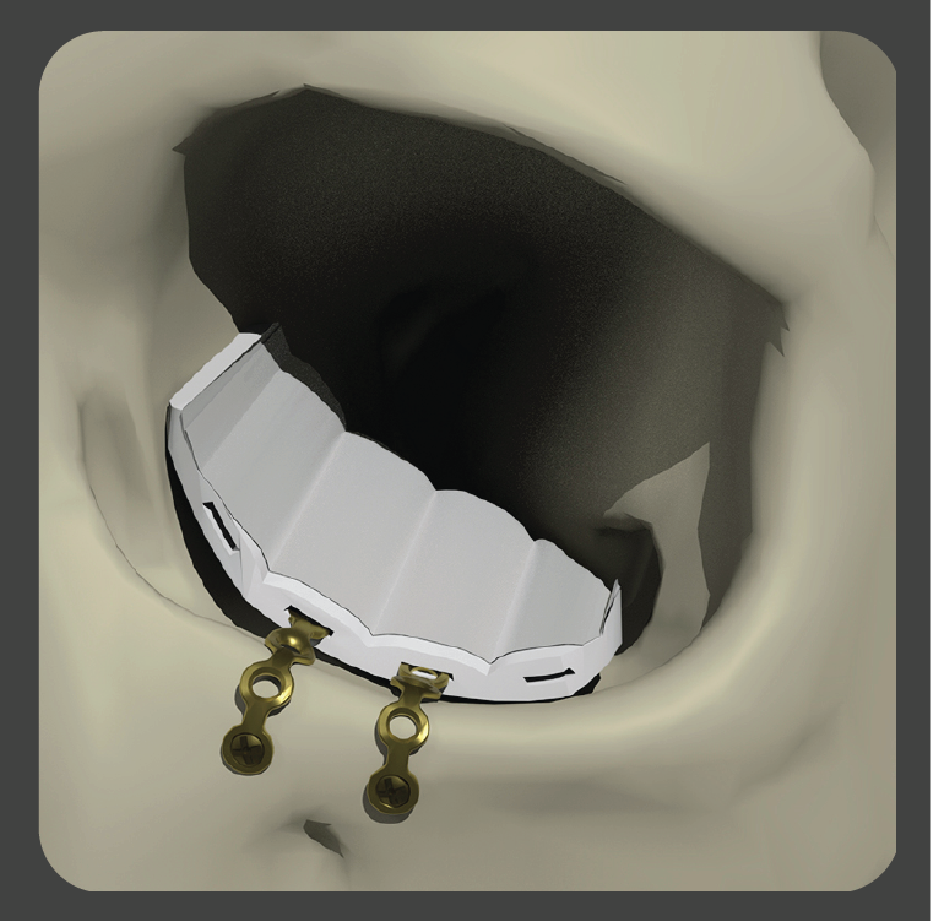 stupid-02 White rectangular implant with vertical channels for drainage