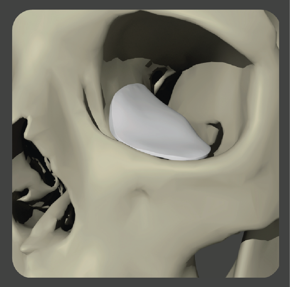 stupid-03 Curved white wedge-shaped implant for orbital floor support