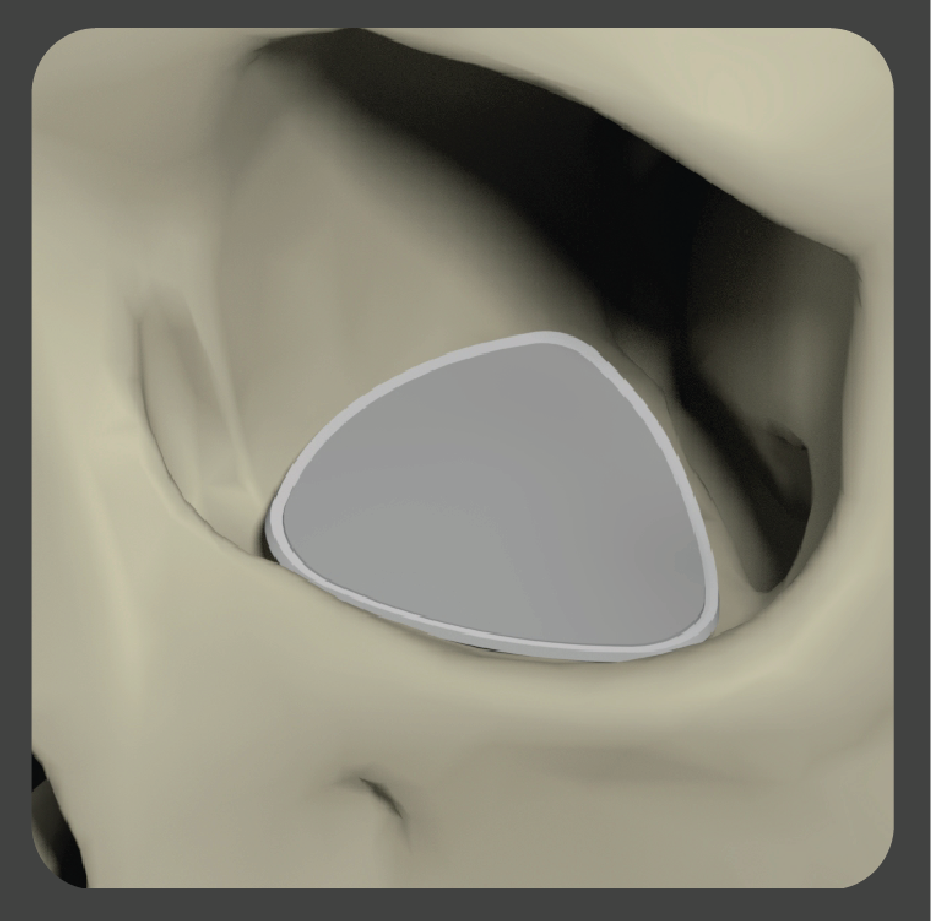 stupid-04 White triangular plate implant for orbital floor reconstruction