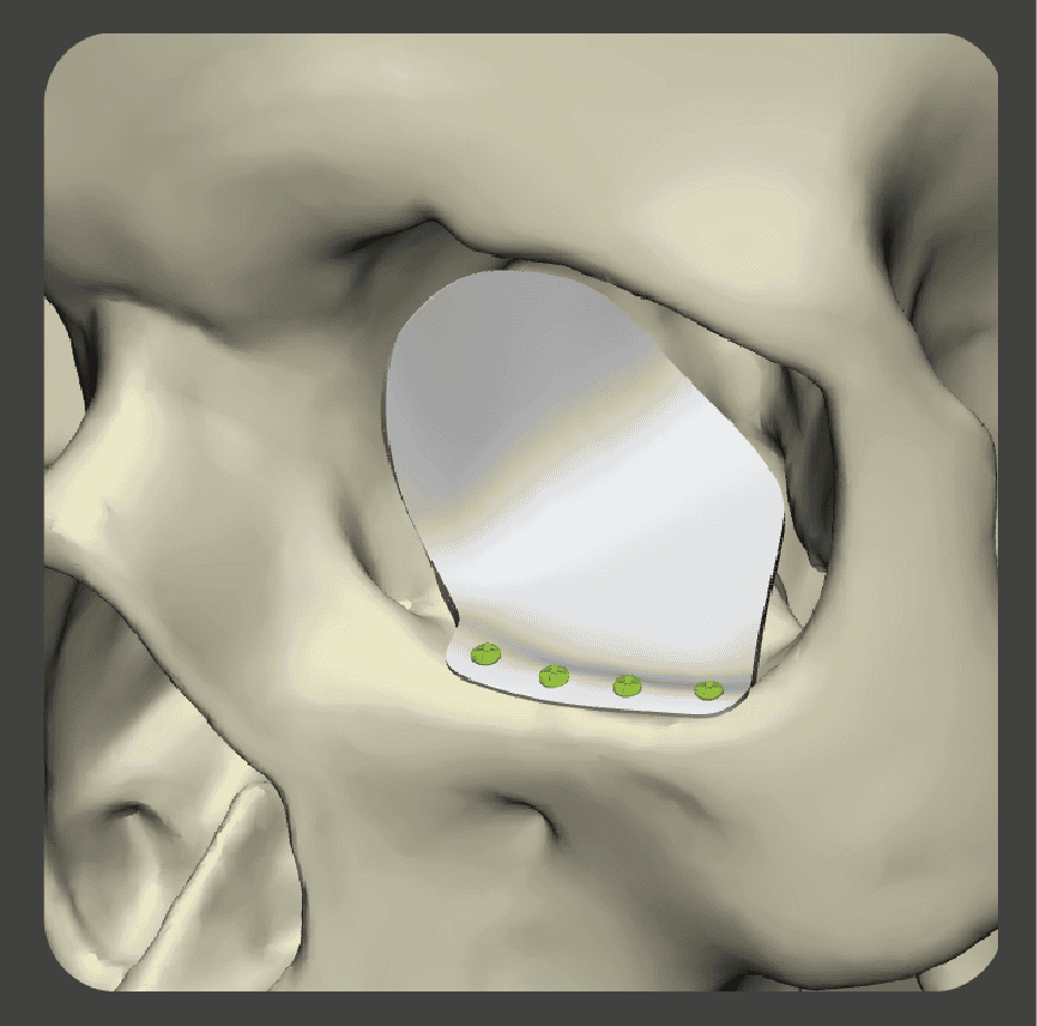 Collage showing medical research team, surgeons consulting, patient procedure, and SU-POR porous polyethylene implants