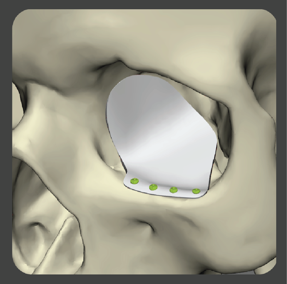 stupid-05 White L-shaped implant designed for orbital floor reconstruction