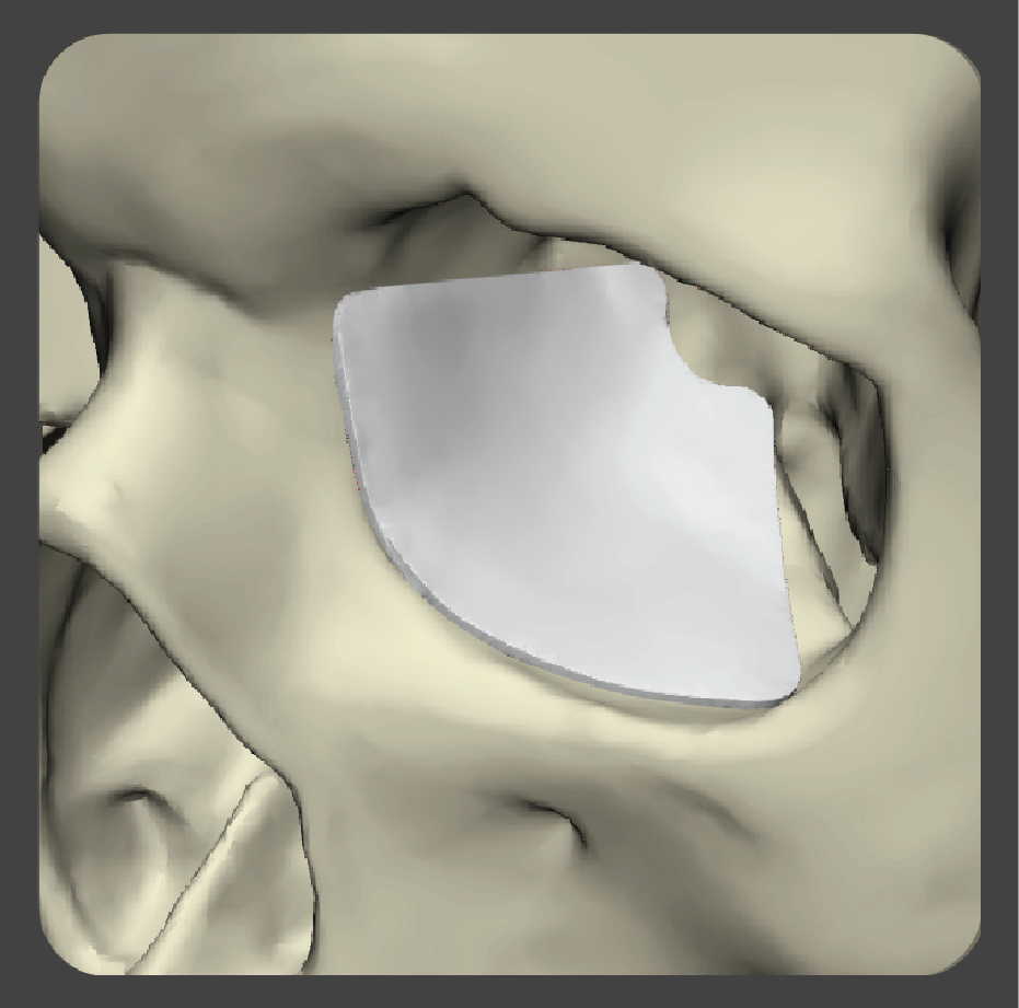 stupoid-03 White fan-shaped implant with curved edges for orbital support